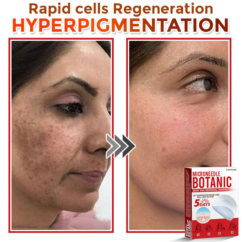 MicroNeedle Botanic Skin Tag Removal Patch