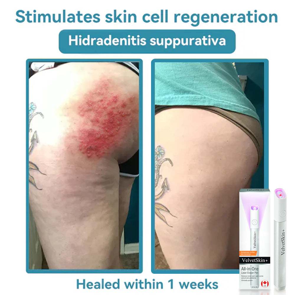 ✨EETTSY™ All-in-One CO₂ Laser Eraser Pen | Removes Moles, Warts, Skin Flaws & Pigmentation