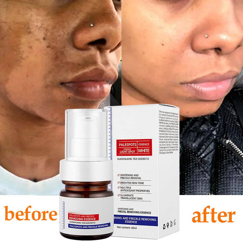 🔥3-day freckle removal: Freckles Disappear, Pigmentation Dissipates, and Skin looks brand New! ✨Vitamin C Freckle Removal Essence➡️