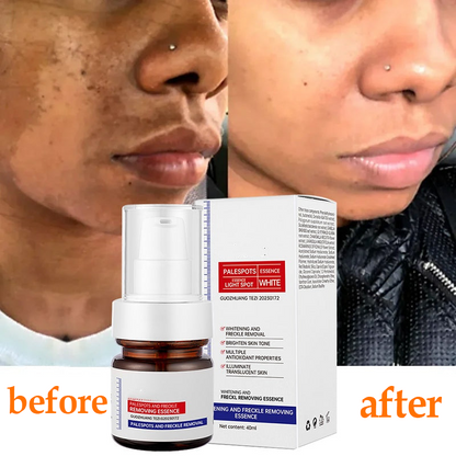 🔥3-day freckle removal: Freckles Disappear, Pigmentation Dissipates, and Skin looks brand New! ✨Vitamin C Freckle Removal Essence➡️