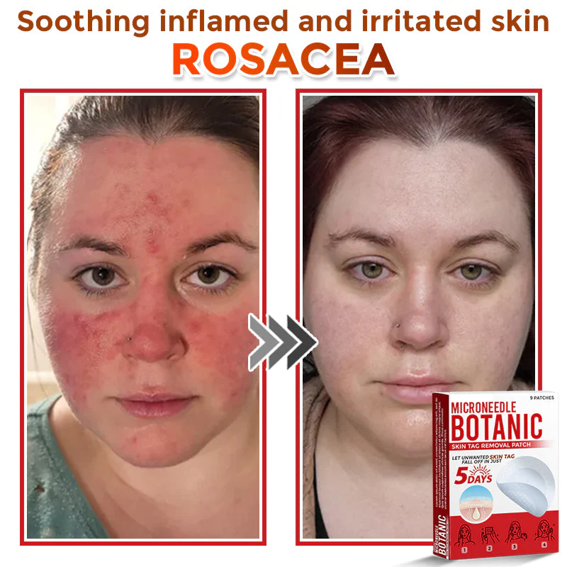 MicroNeedle Botanic Skin Tag Removal Patch
