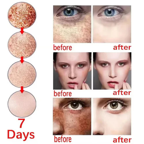 🔥3-day freckle removal: Freckles Disappear, Pigmentation Dissipates, and Skin looks brand New! ✨Vitamin C Freckle Removal Essence➡️