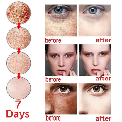 🔥3-day freckle removal: Freckles Disappear, Pigmentation Dissipates, and Skin looks brand New! ✨Vitamin C Freckle Removal Essence➡️