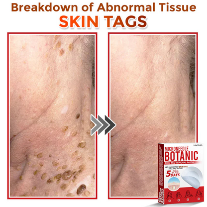 MicroNeedle Botanic Skin Tag Removal Patch