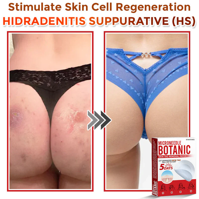 MicroNeedle Botanic Skin Tag Removal Patch
