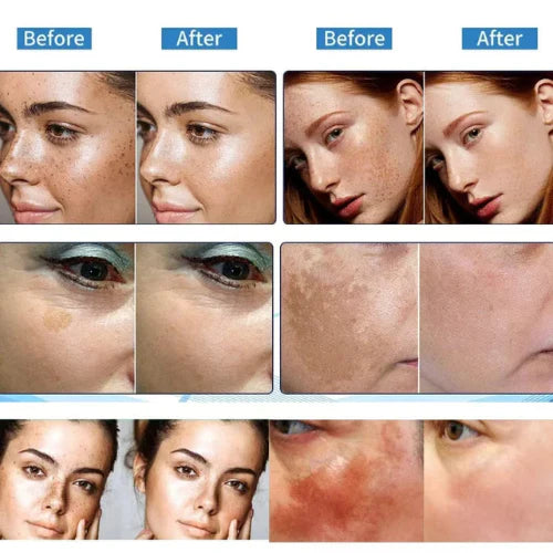 🔥3-day freckle removal: Freckles Disappear, Pigmentation Dissipates, and Skin looks brand New! ✨Vitamin C Freckle Removal Essence➡️